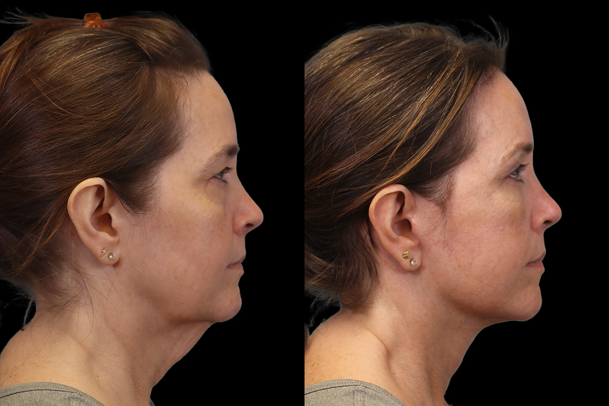 Facelift Before & After Gallery - Patient 102540 - Image 3