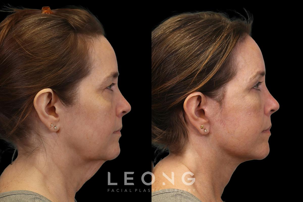 Facelift Before & After Gallery - Patient 102540 - Image 3