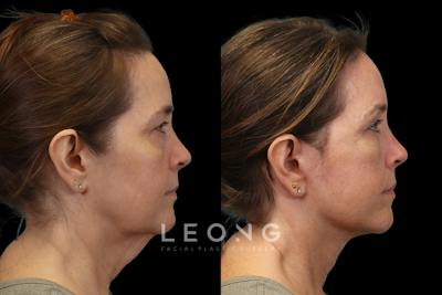 Deep Neck Lift Before & After Gallery - Patient 252911 - Image 1