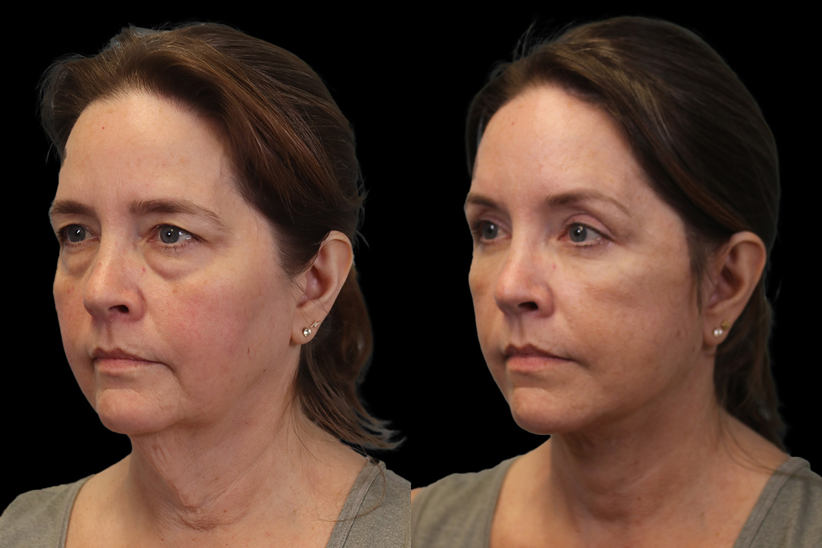 Facelift Before & After Gallery - Patient 102540 - Image 4