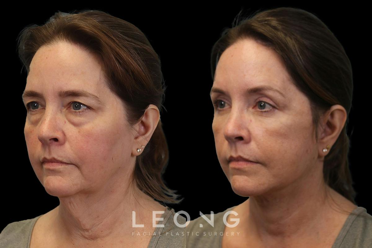 Facelift Before & After Gallery - Patient 102540 - Image 4
