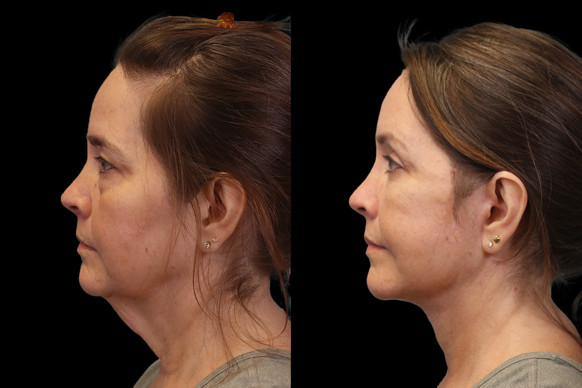 Facelift Before & After Gallery - Patient 102540 - Image 5