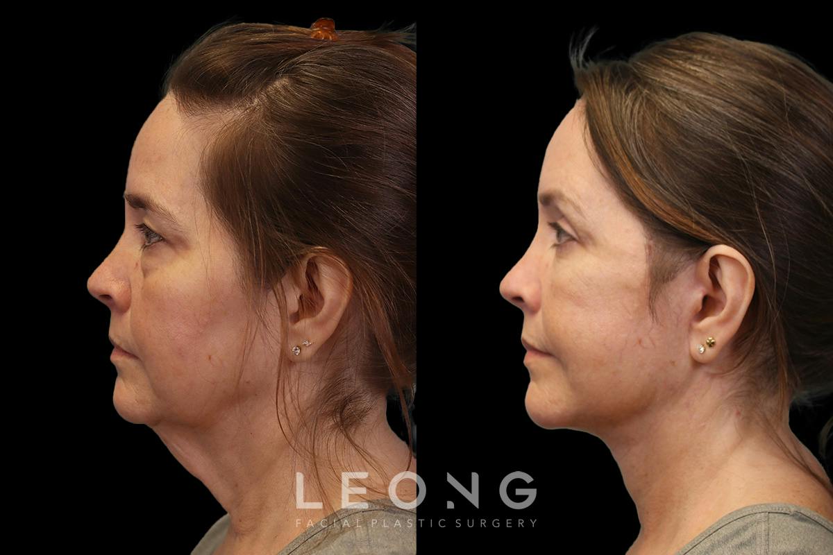 Facelift Before & After Gallery - Patient 102540 - Image 5