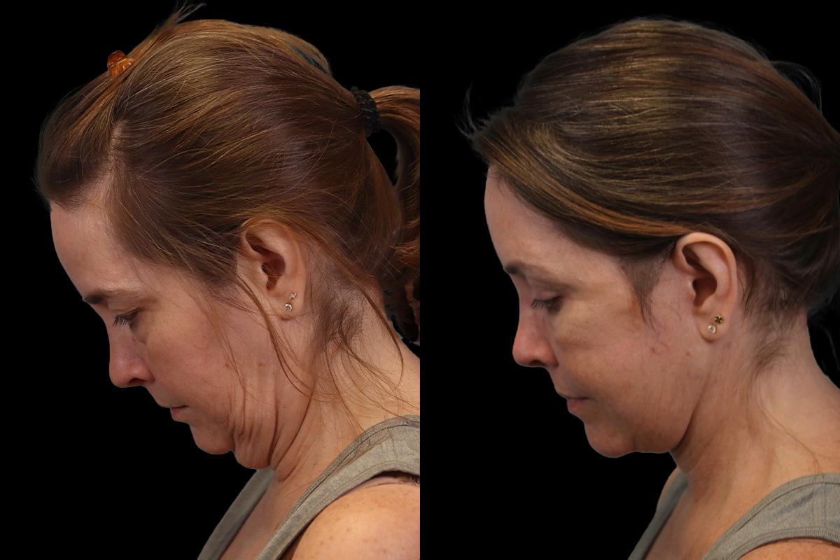 Facelift Before & After Gallery - Patient 102540 - Image 6