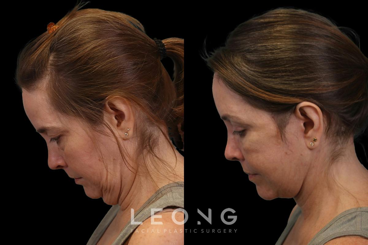 Facelift Before & After Gallery - Patient 102540 - Image 6