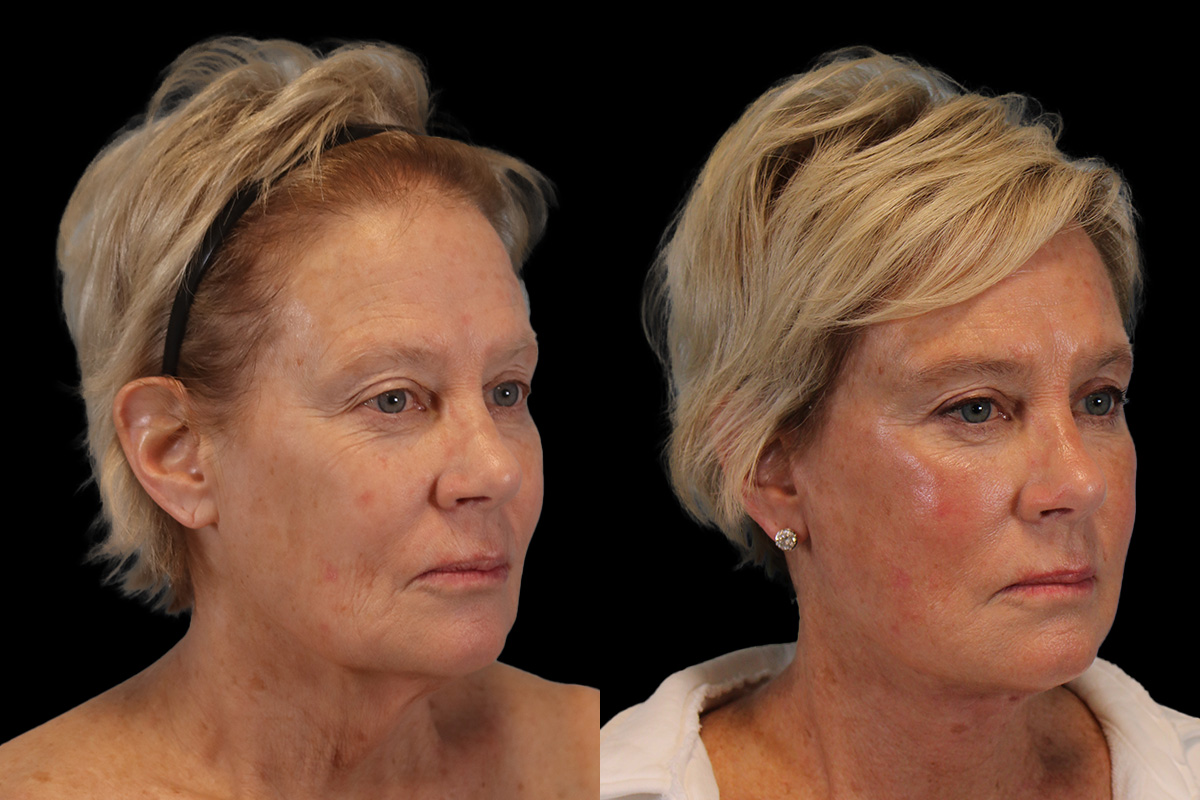 Facelift Before & After Gallery - Patient 393162 - Image 2