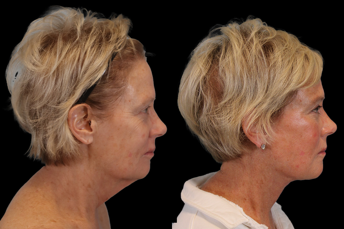 Facelift Before & After Gallery - Patient 393162 - Image 3