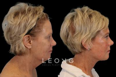 Deep Neck Lift Before & After Gallery - Patient 241549 - Image 1