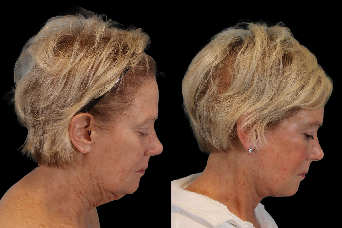 Facelift Before & After Gallery - Patient 393162 - Image 4