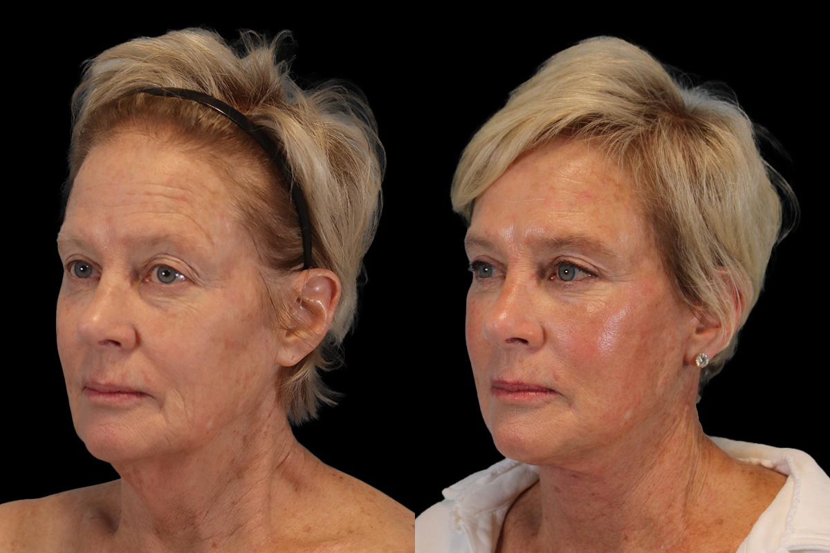 Facelift Before & After Gallery - Patient 393162 - Image 5