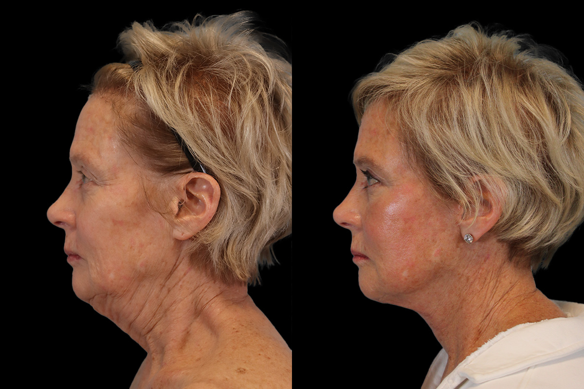Facelift Before & After Gallery - Patient 393162 - Image 6