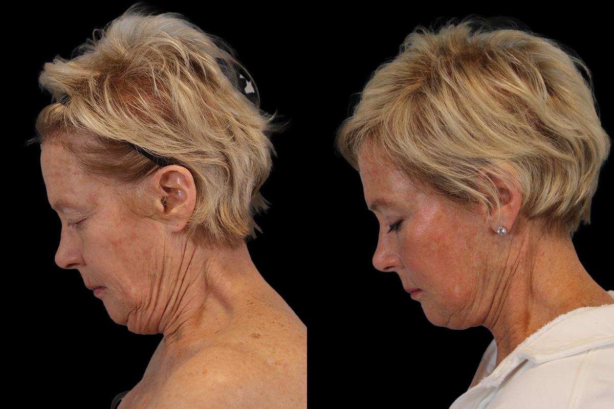Facelift Before & After Gallery - Patient 393162 - Image 7