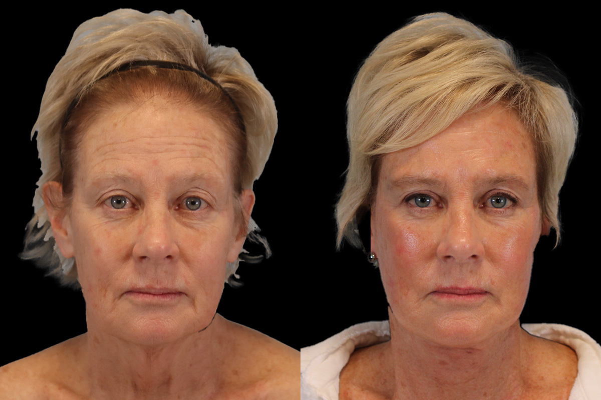 Facelift Before & After Gallery - Patient 393162 - Image 1