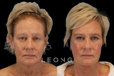 Blepharoplasty Before & After Gallery - Patient 320065 - Image 1