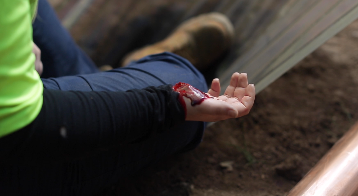 Lacerations & Injuries