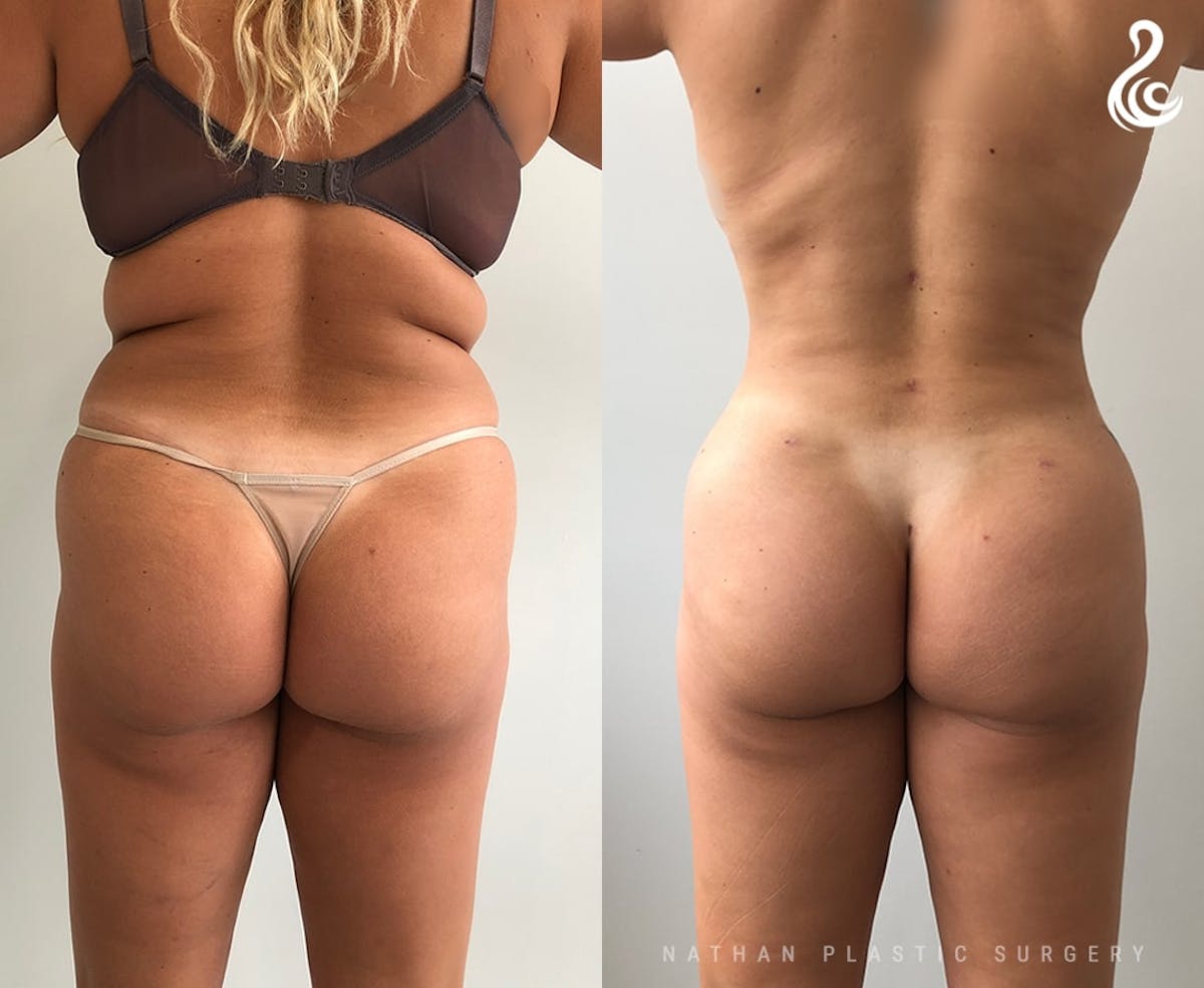 Liposuction Before & After Gallery - Patient 329009 - Image 2