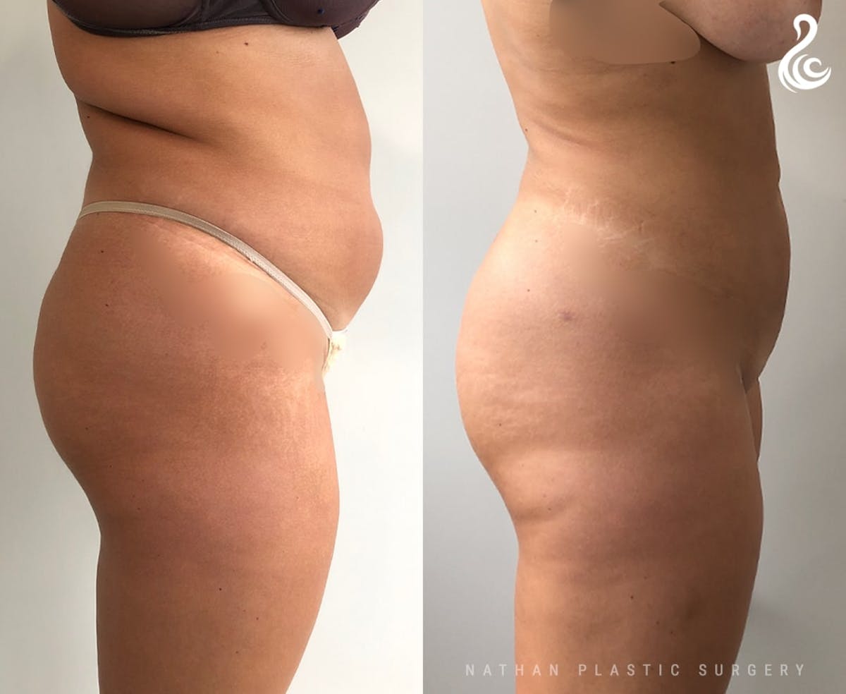Liposuction Before & After Gallery - Patient 329009 - Image 3