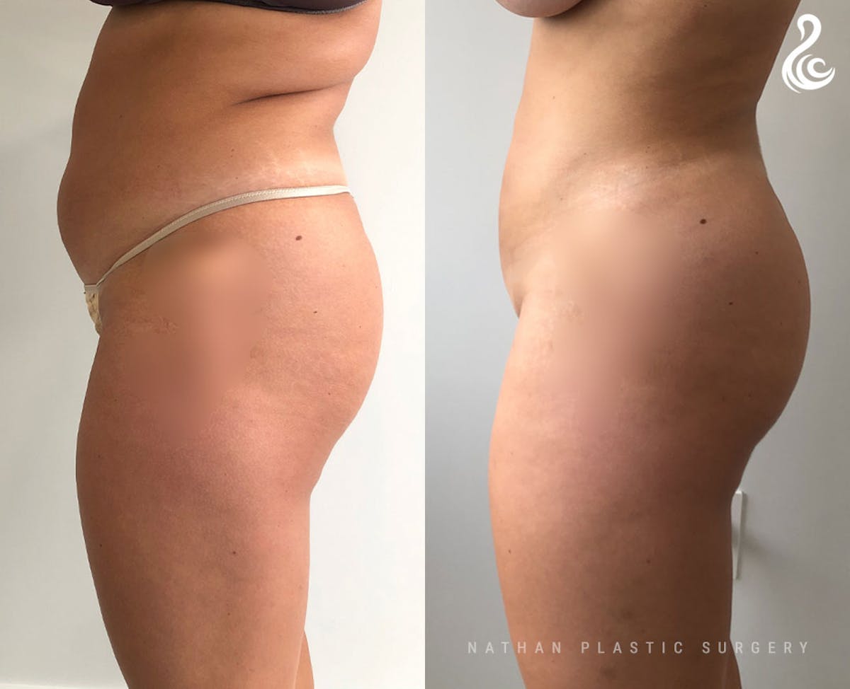 Liposuction Before & After Gallery - Patient 329009 - Image 4