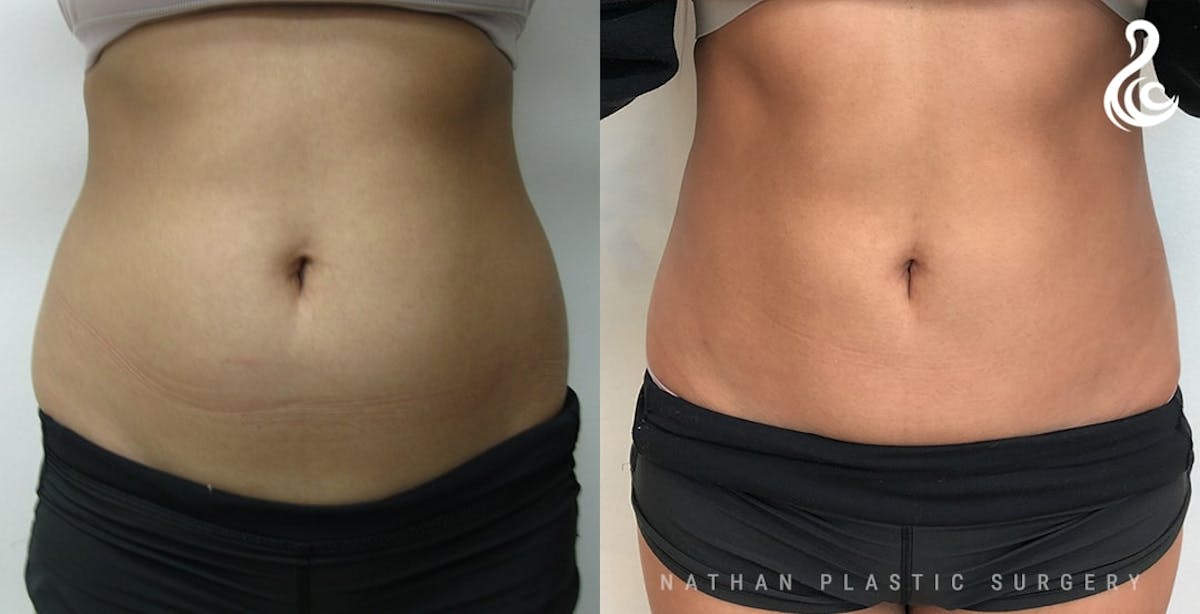 Liposuction Before & After Gallery - Patient 113381 - Image 1