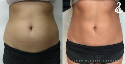 Liposuction Before & After Gallery - Patient 113381 - Image 1