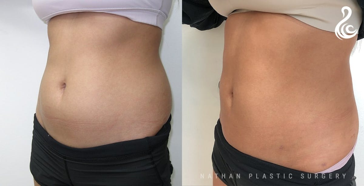 Liposuction Before & After Gallery - Patient 113381 - Image 2