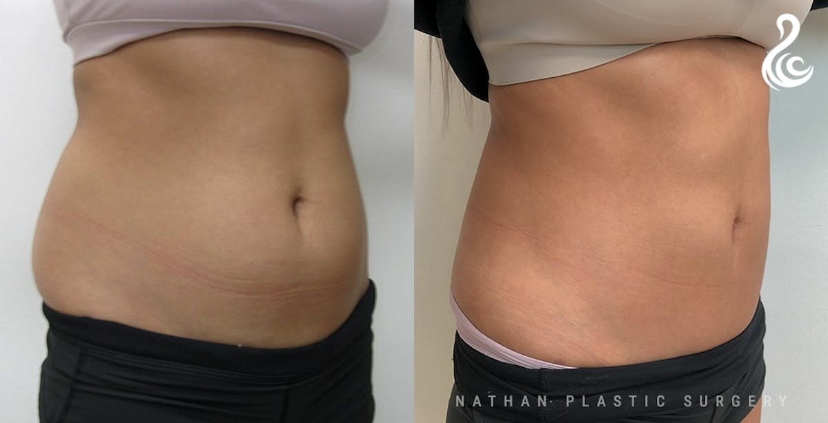 Liposuction Before & After Gallery - Patient 113381 - Image 3