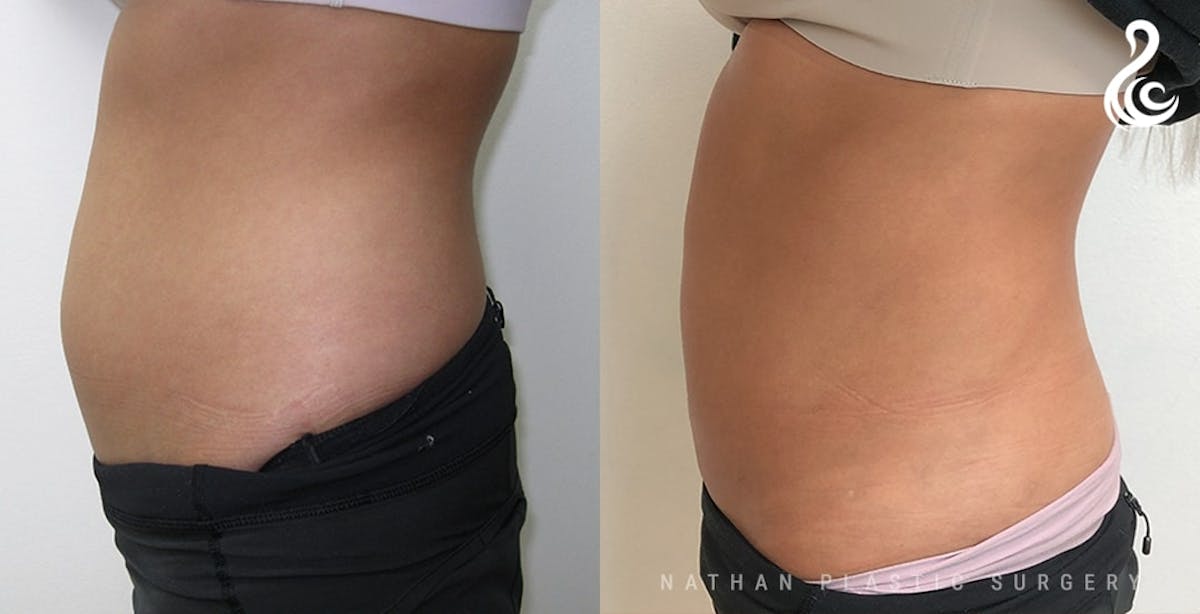 Liposuction Before & After Gallery - Patient 113381 - Image 4
