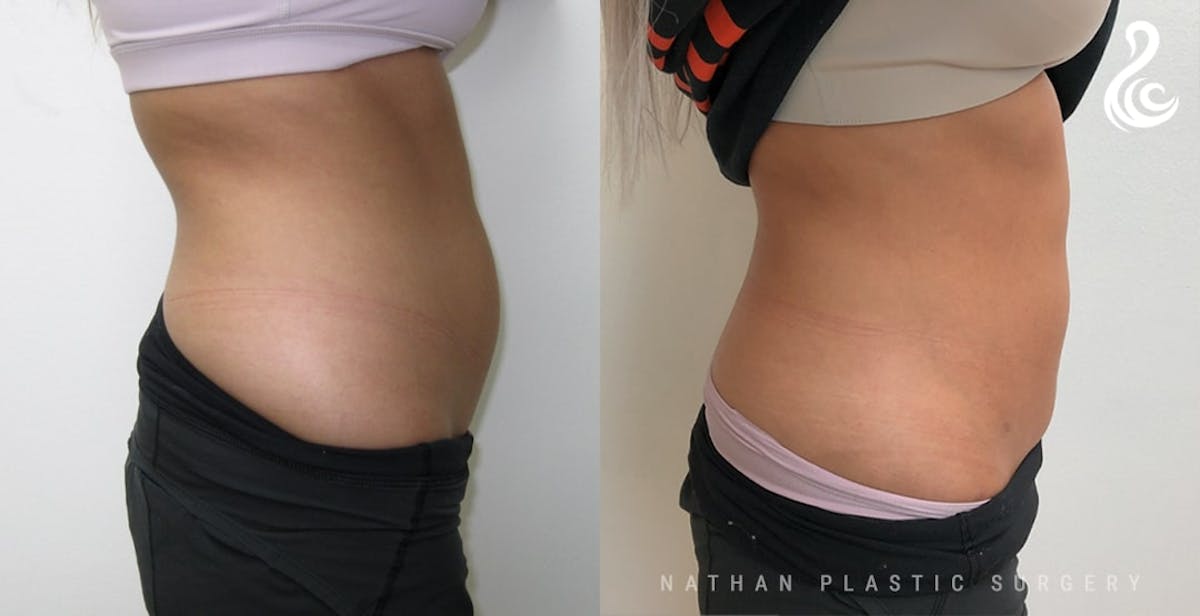 Liposuction Before & After Gallery - Patient 113381 - Image 5