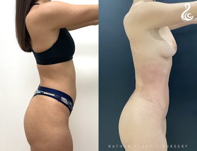 Liposuction Before & After Gallery - Patient 338941 - Image 1