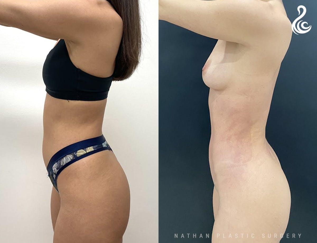 Liposuction Before & After Gallery - Patient 338941 - Image 2