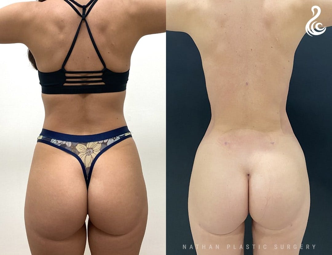 Liposuction Before & After Gallery - Patient 338941 - Image 3