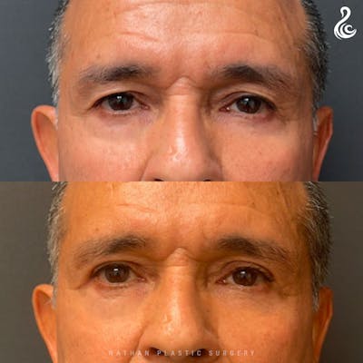 Eyelid Surgery Before & After Gallery - Patient 134833 - Image 1