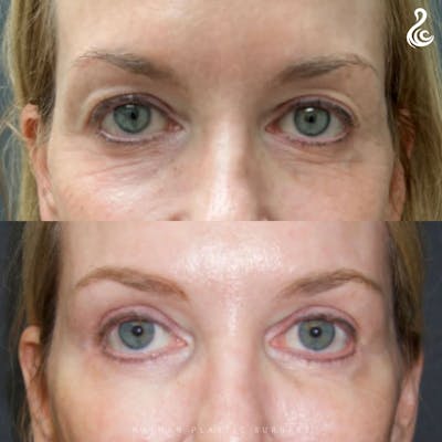 Eyelid Surgery Before & After Gallery - Patient 157368 - Image 1