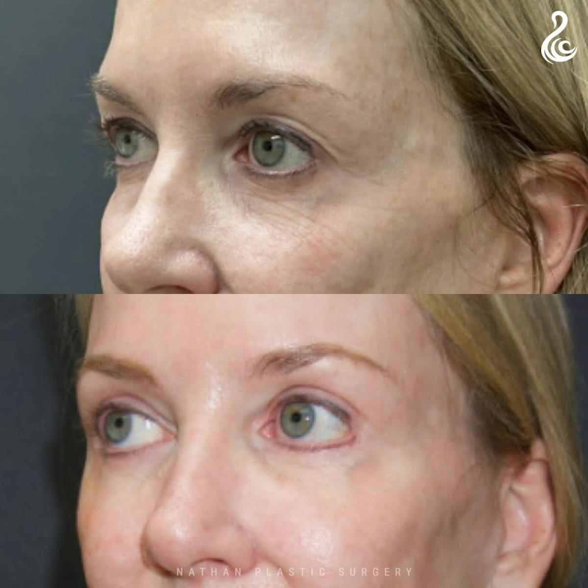 Eyelid Surgery Before & After Gallery - Patient 157368 - Image 2