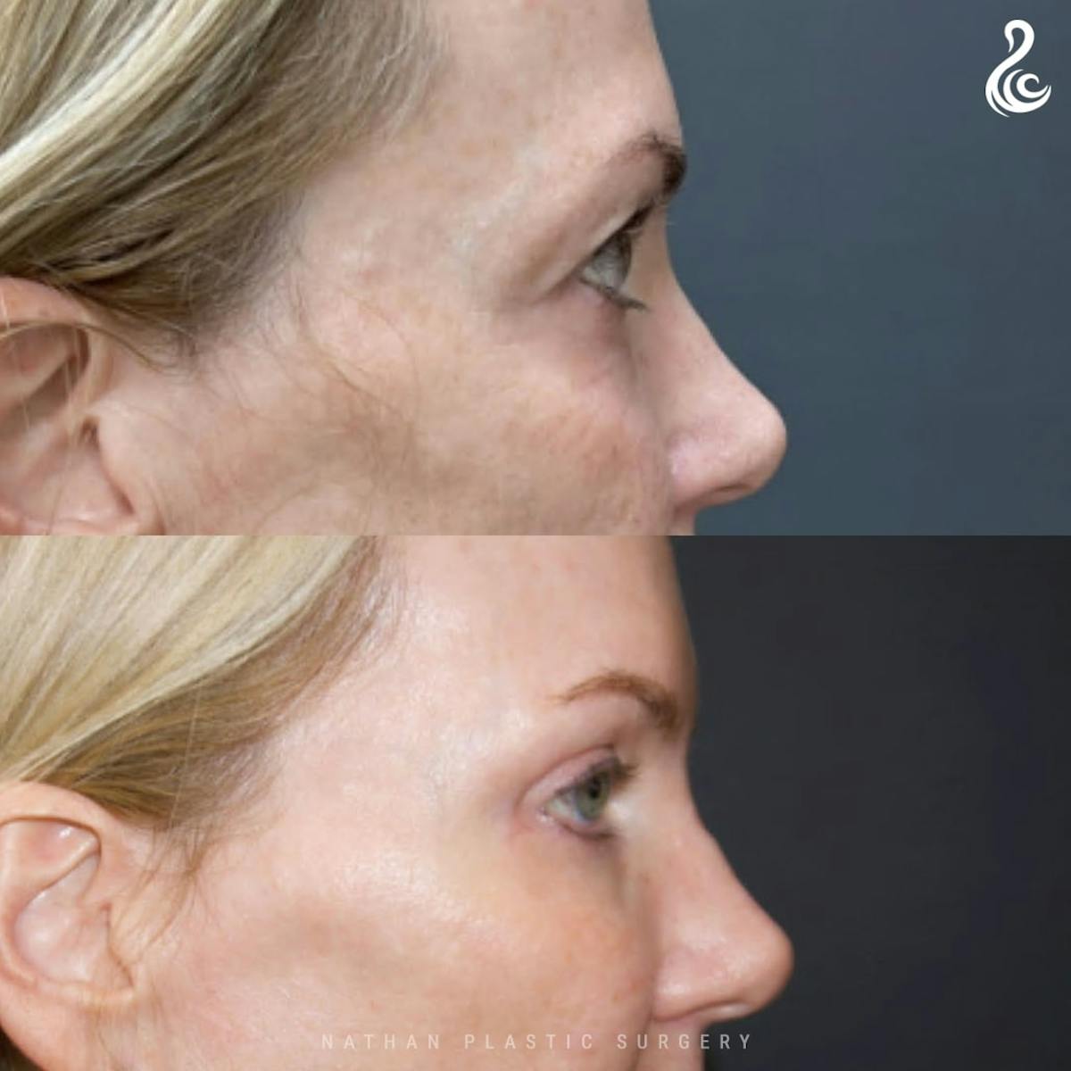 Eyelid Surgery Before & After Gallery - Patient 157368 - Image 5