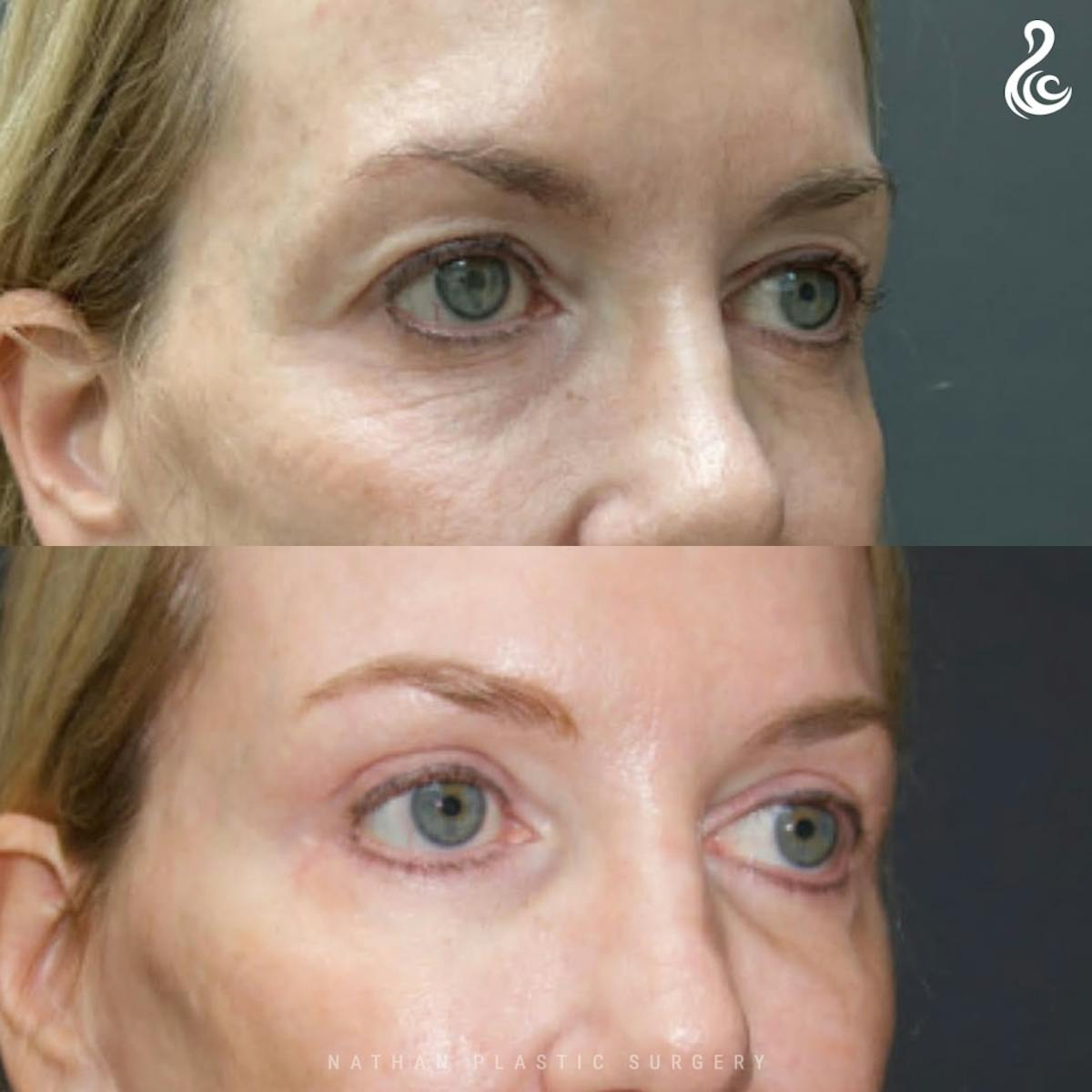 Eyelid Surgery Before & After Gallery - Patient 157368 - Image 3