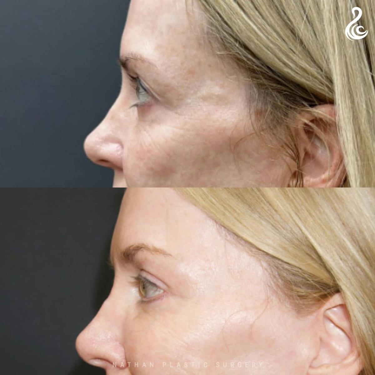 Eyelid Surgery Before & After Gallery - Patient 157368 - Image 4