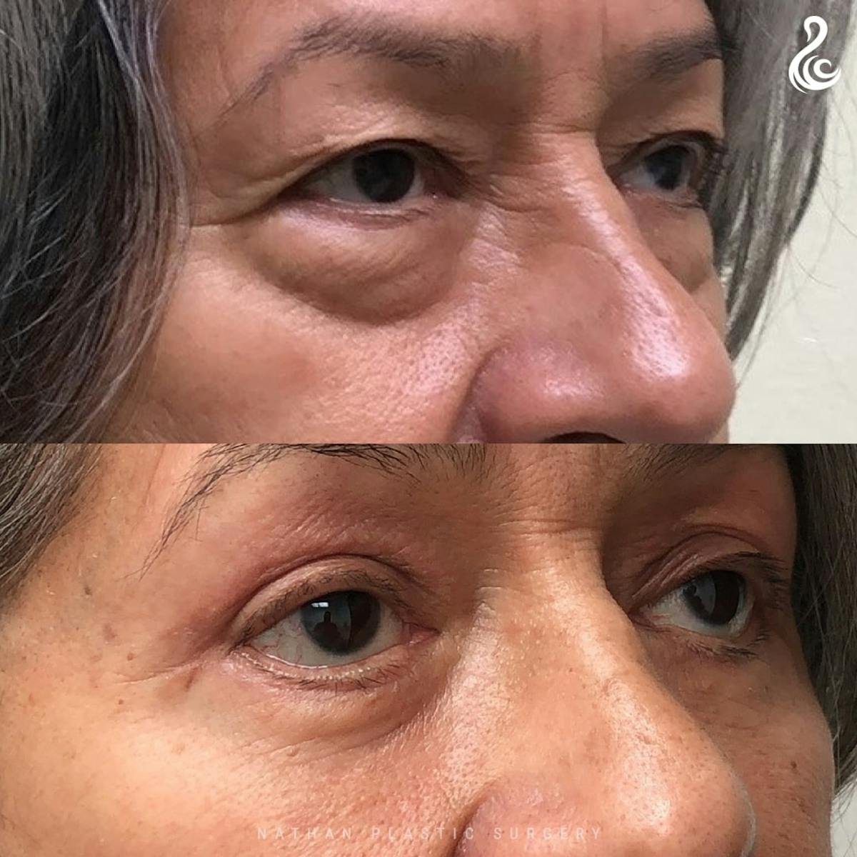 Eyelid Surgery Before & After Gallery - Patient 571337 - Image 1