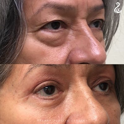 Eyelid Surgery Before & After Gallery - Patient 571337 - Image 1
