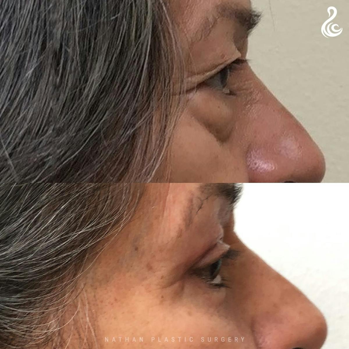Eyelid Surgery Before & After Gallery - Patient 571337 - Image 2