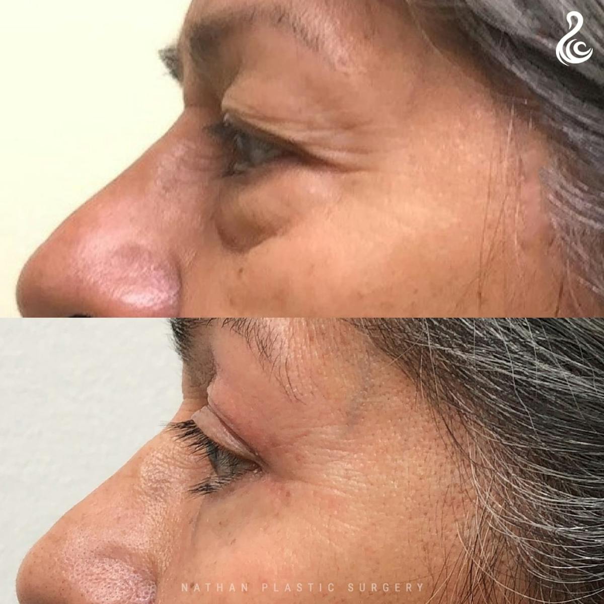 Eyelid Surgery Before & After Gallery - Patient 571337 - Image 4