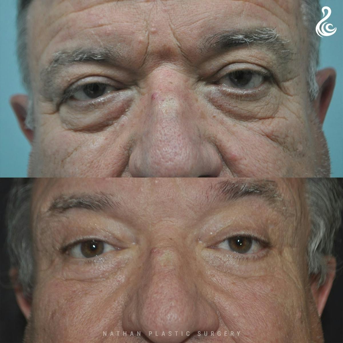 Eyelid Surgery Before & After Gallery - Patient 111099 - Image 1
