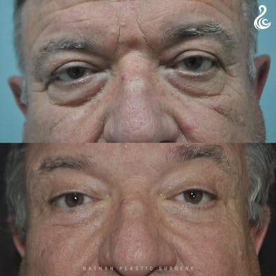 Eyelid Surgery Before & After Gallery - Patient 111099 - Image 1