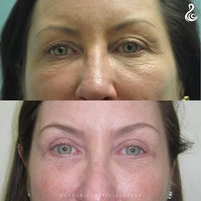 Eyelid Surgery Before & After Gallery - Patient 339516 - Image 1