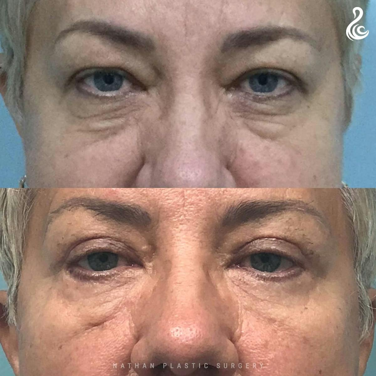 Eyelid Surgery Before & After Gallery - Patient 114814 - Image 1