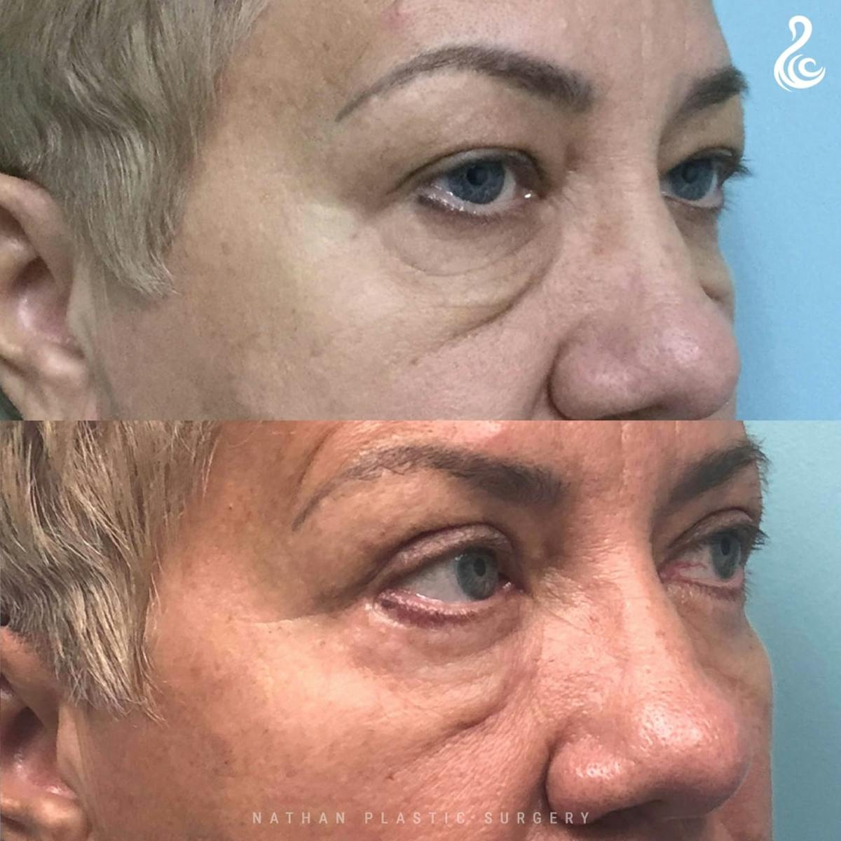 Eyelid Surgery Before & After Gallery - Patient 114814 - Image 2