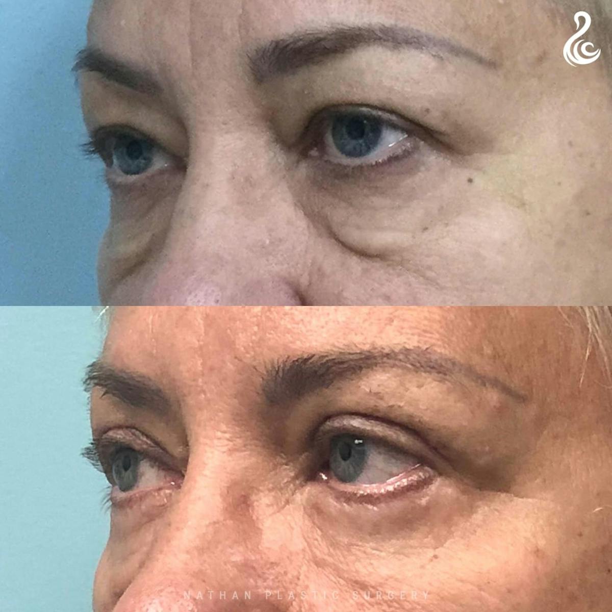 Eyelid Surgery Before & After Gallery - Patient 114814 - Image 3