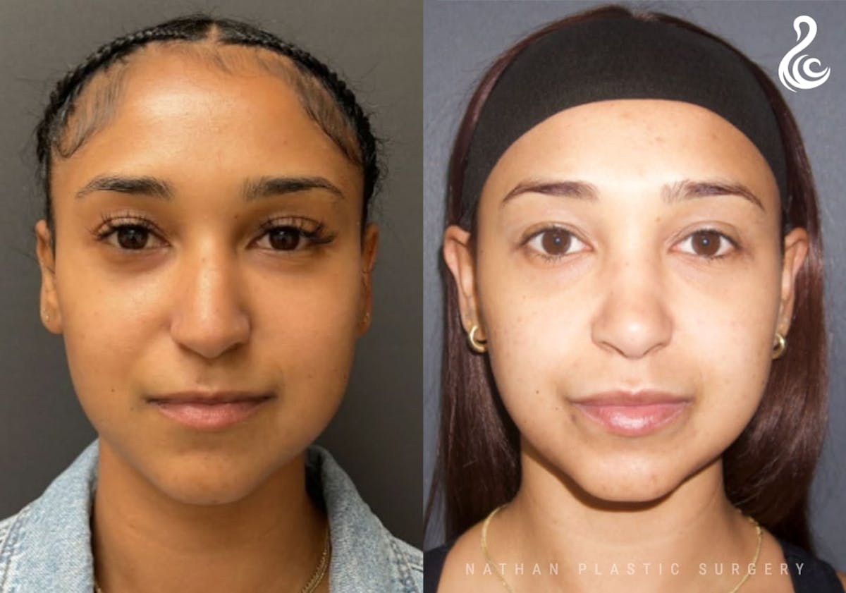 Rhinoplasty Before & After Gallery - Patient 371730 - Image 3