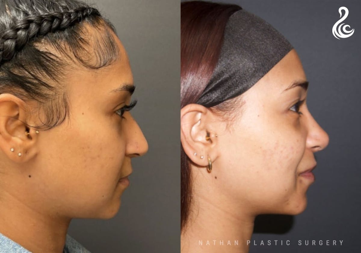 Rhinoplasty Before & After Gallery - Patient 371730 - Image 2