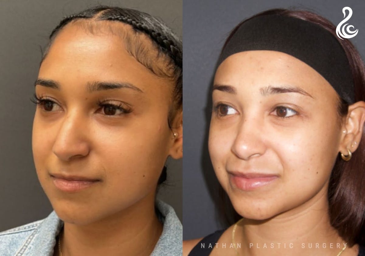 Rhinoplasty Before & After Gallery - Patient 371730 - Image 4